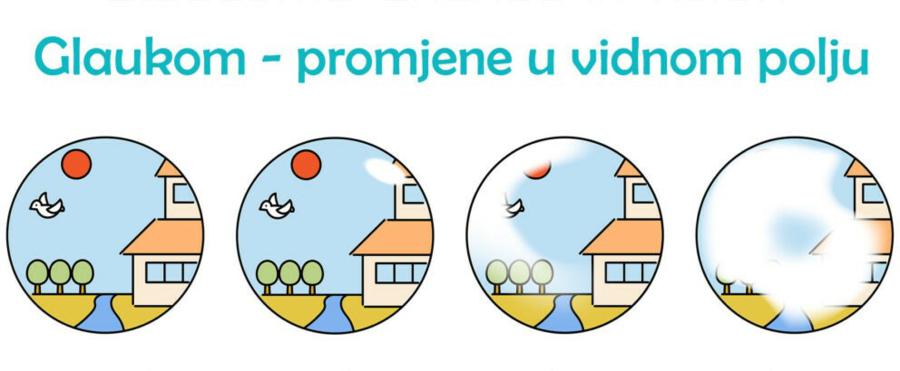 Svjetski tjedan glaukoma - tjedan borbe protiv bolesti koja uzrokuje nepovratan gubitak vida